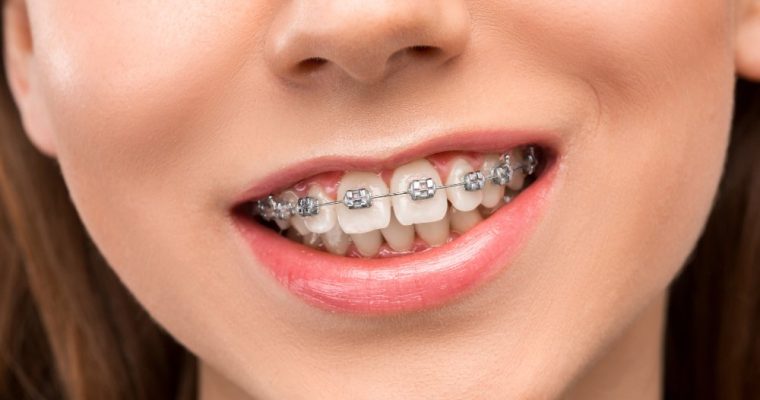 How Long Do You Need to Wear Braces?
