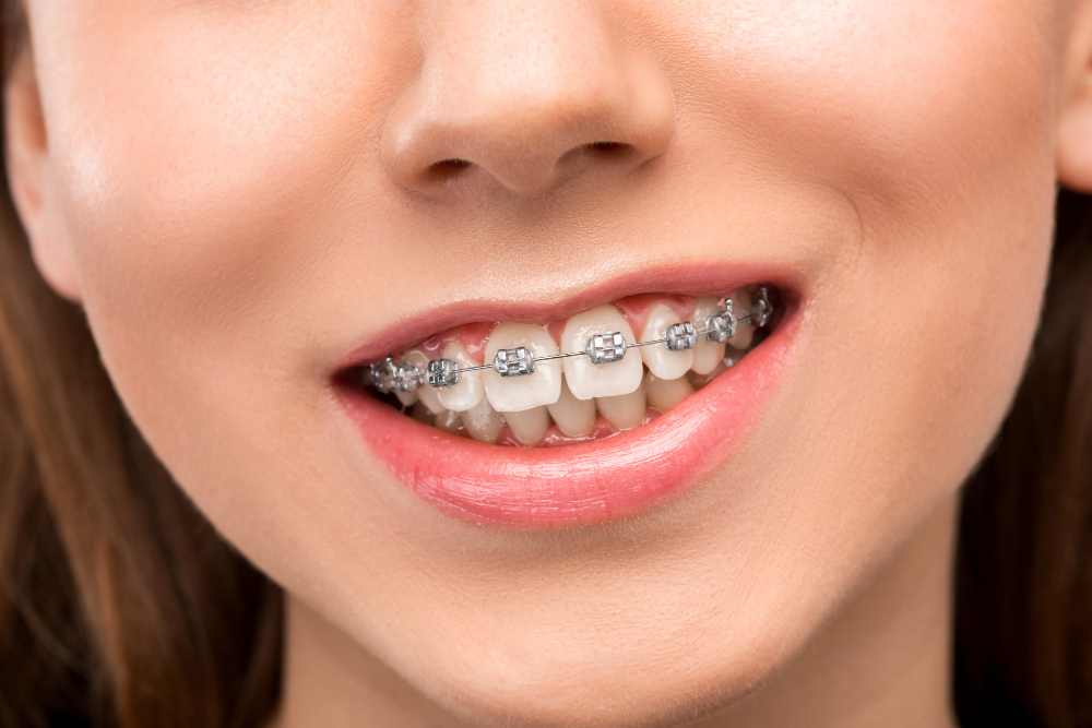 How Long Do You Need to Wear Braces