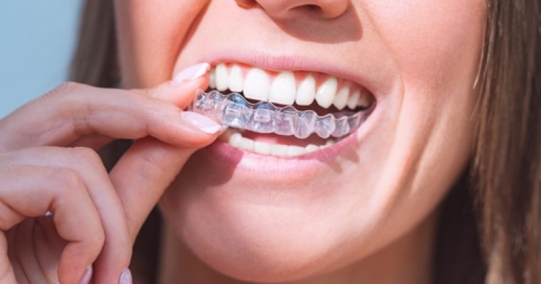 How Long Does Invisalign Take to Straighten Your Teeth?
