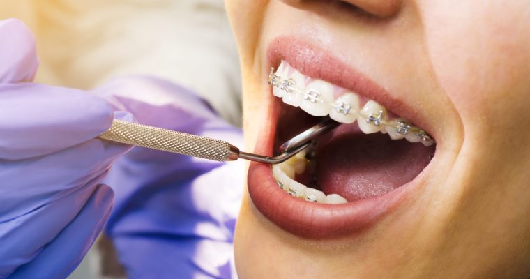 How to Pick the Best Braces Colors for Your Teeth